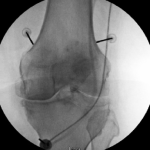 Discover Pain Relief Without Surgery: Radiofrequency ablation for knee pain